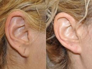 🥇 Earlobe Repair for Stretched or Torn Ears